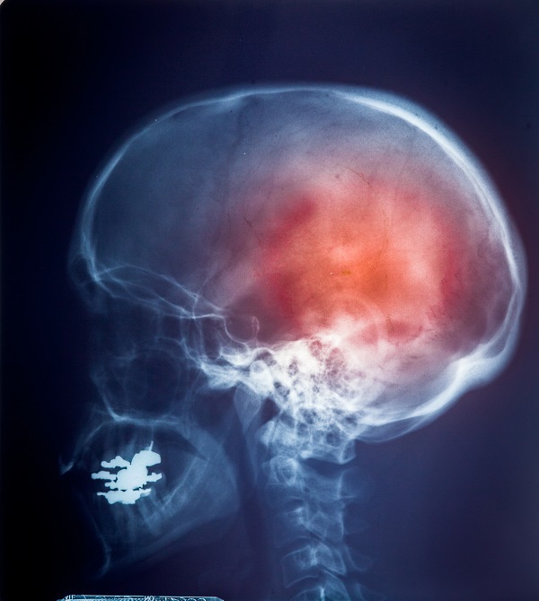 Open vs. Closed Traumatic Brain Injuries