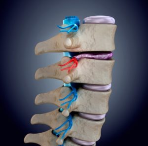 Spinal cord under pressure of bulging disc